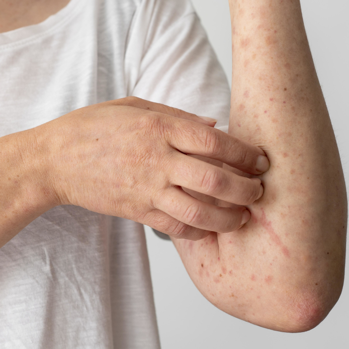 MMR Vaccination for Adults (2 Doses)