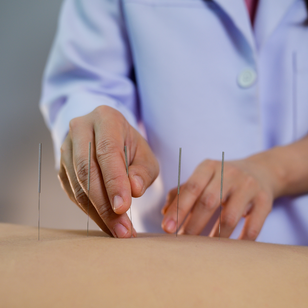TCM Acupuncture with Consultation